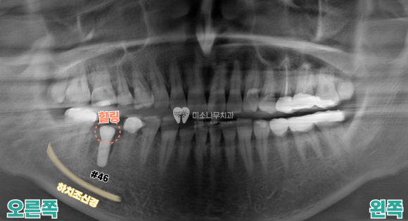 치아 엑스레이 사진