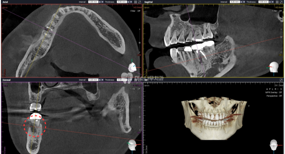 치아 3D CT 사진