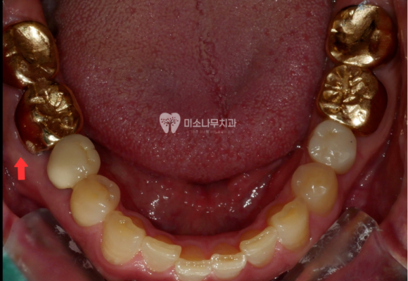 치아 사진