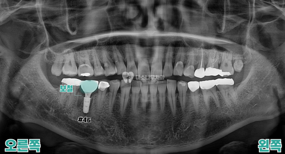 치아 엑스레이 사진
