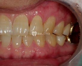 다문 치아 사진