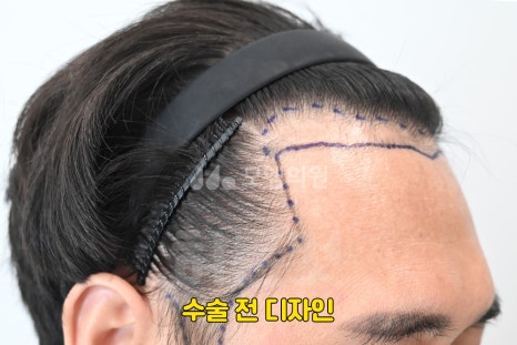 중앙헤어라인 이미지