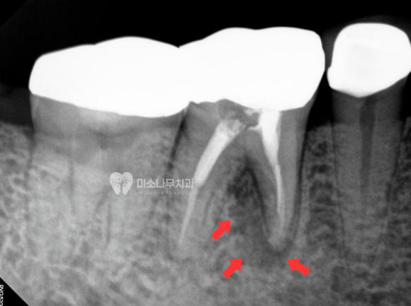 치아 뿌리 엑스레이 사진