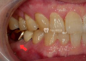 다문 치아 사진
