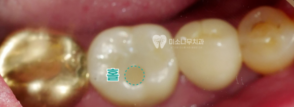 치아에 구멍 뚫린 사진