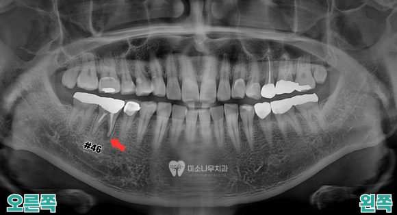 45세 남성 치아 엑스레이