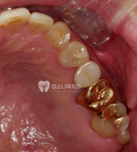 오른쪽 어금니 사진