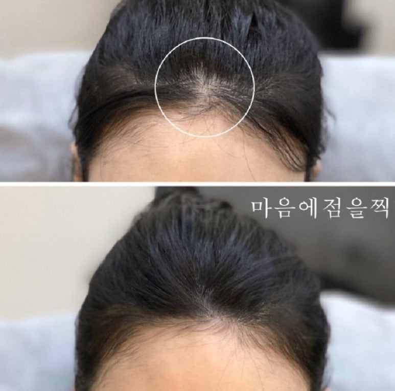 마음에점을찍다두피SMP 이미지
