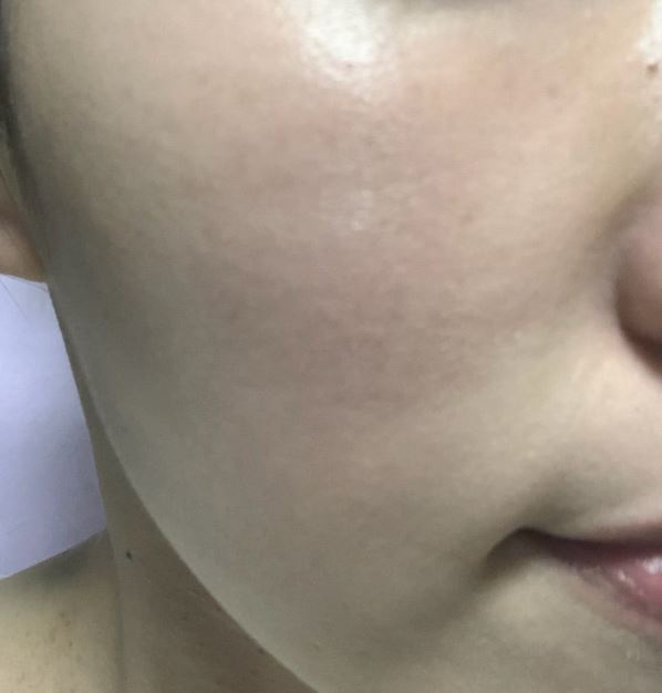 고주파 리페어 이미지