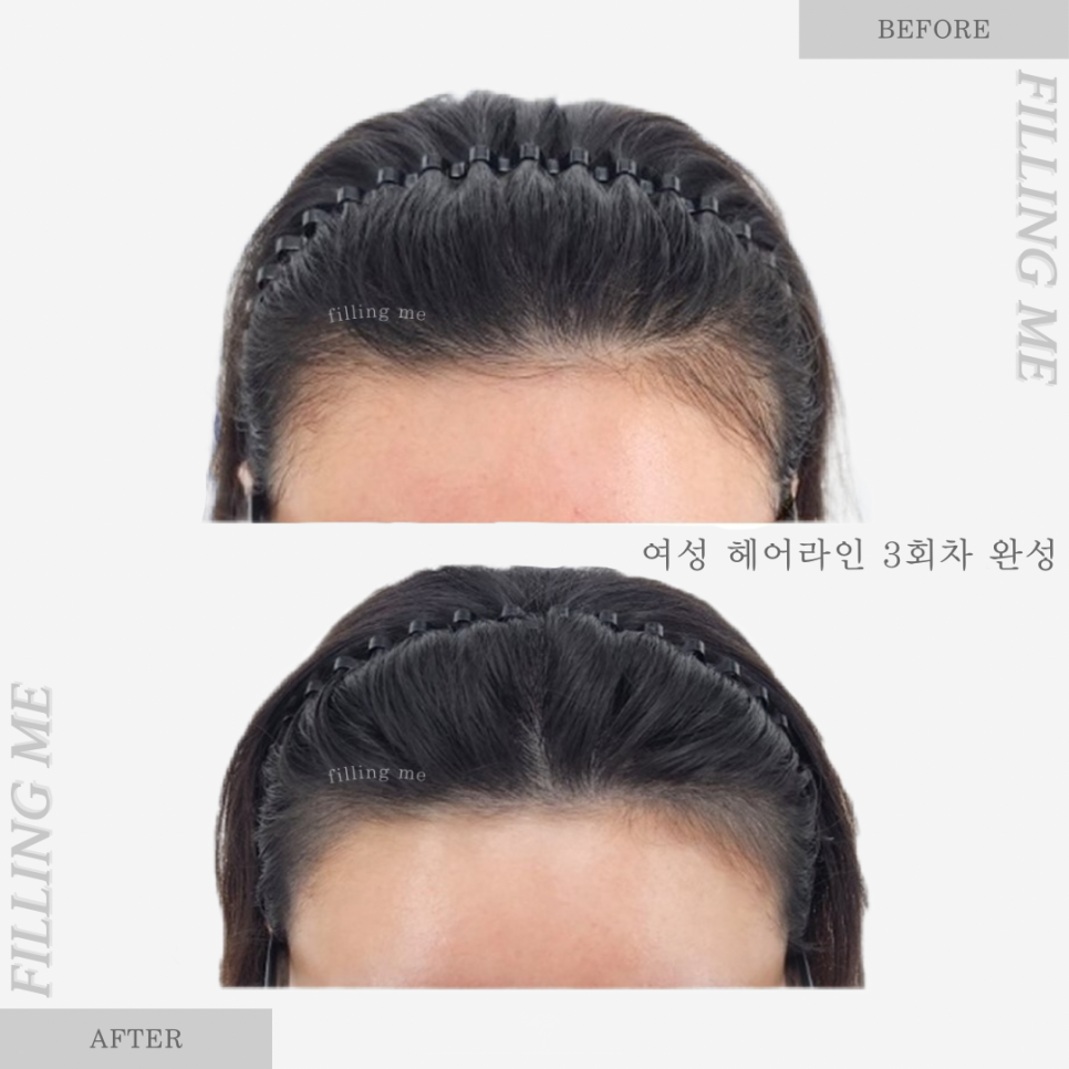 미가헤어라인 이미지