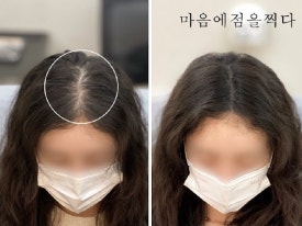 마음에점을찍다두피SMP 이미지