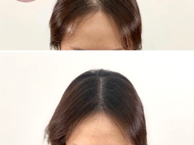 마음에점을찍다두피SMP 이미지