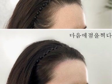 마음에점을찍다두피SMP 이미지