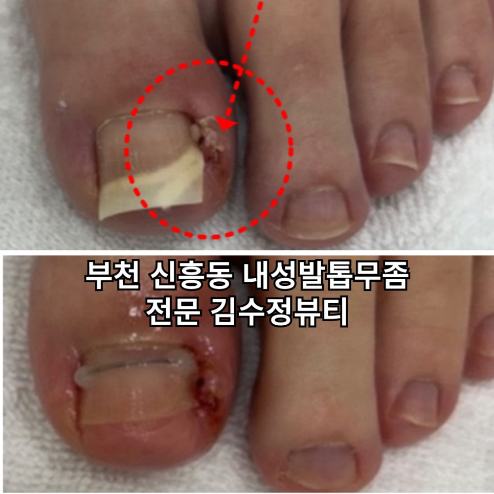 내성발톱발톱무좀관리김수정뷰티 이미지