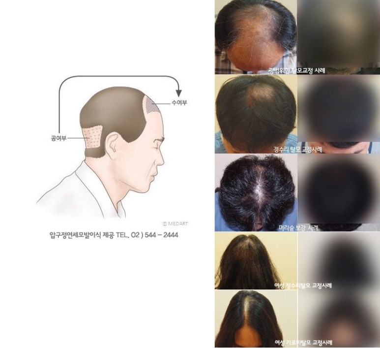 모발을 채우다 이미지