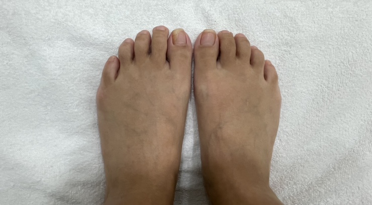 내성발톱발톱무좀관리김수정뷰티 이미지