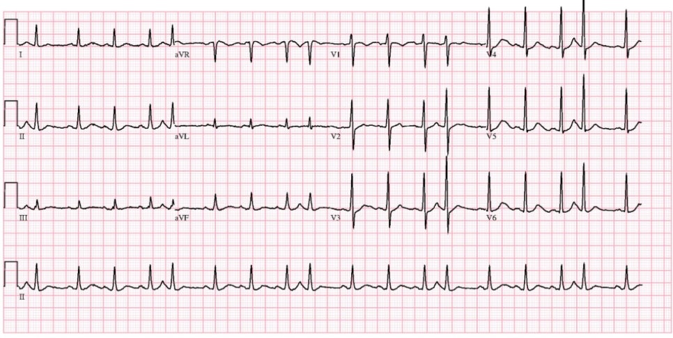 심방조기수축(APC, atrial premature complex) : 네이버 블로그