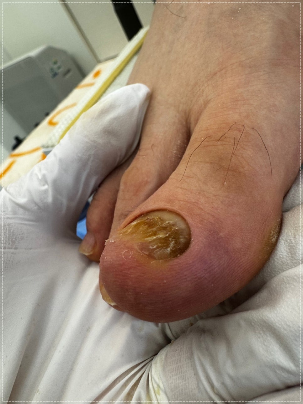 무드비네일닥터아이티엔내성발톱무좀발각질 이미지