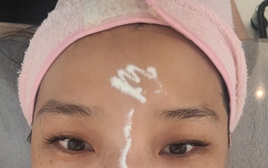 피부아지트(뉴페이스) 이미지