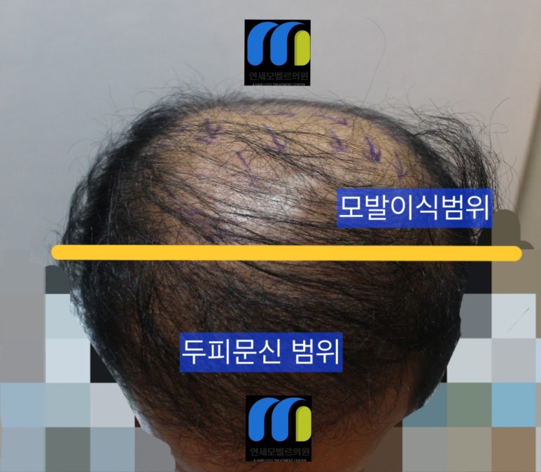오던모발 이미지