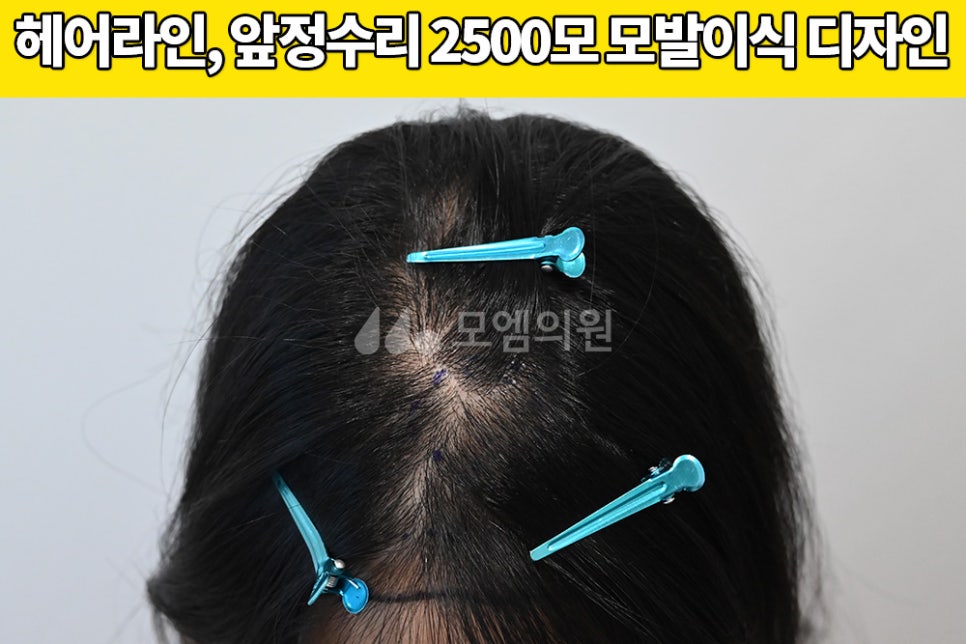중앙헤어라인 이미지
