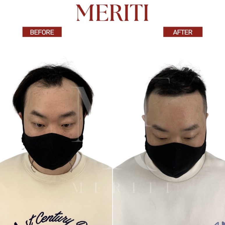 선헤어라인 이미지
