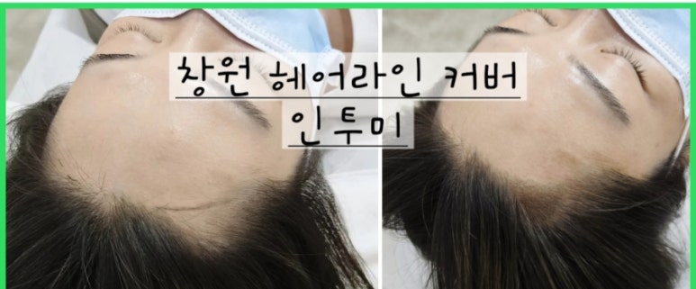 미로헤어라인 이미지