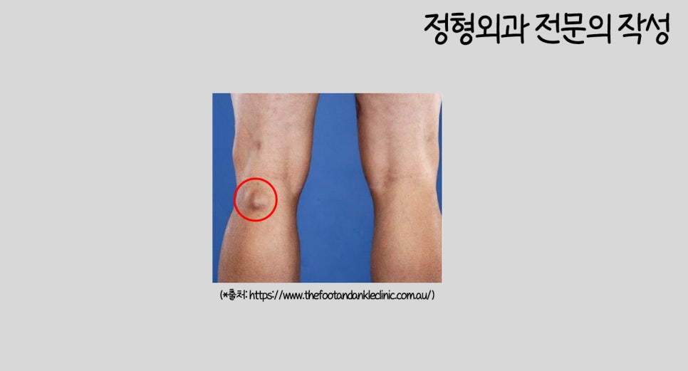 무릎뒤 물혹(베이커낭종) 꼭 제거해야 하나? (주사, 수술) : 네이버 블로그