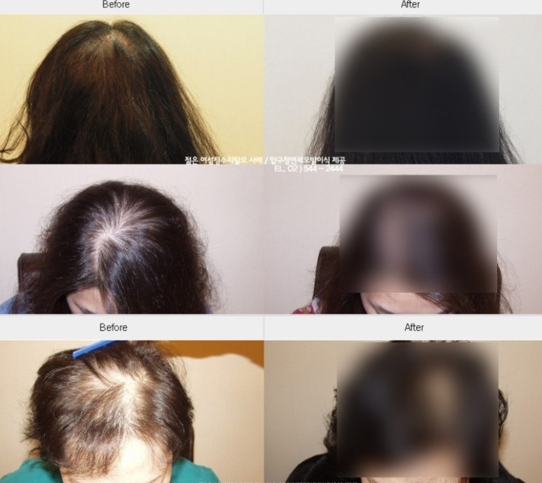 모발을 채우다 이미지
