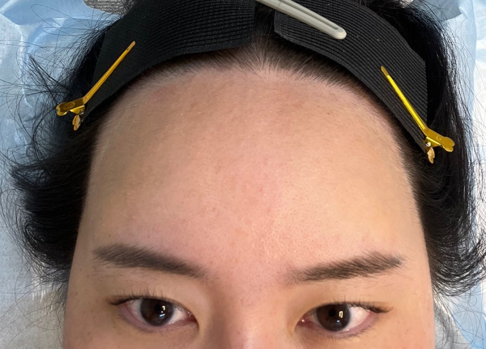 오즈헤어라인 이미지