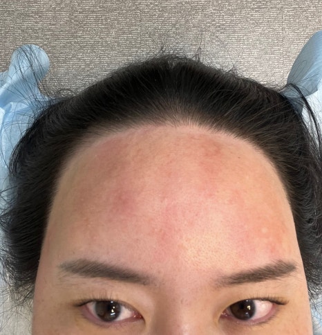 오즈헤어라인 이미지