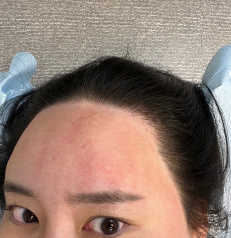 오즈헤어라인 이미지