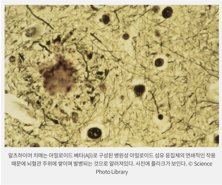 알츠하이머 파킨슨 병 진단 후 치료 방법 알아보기 : 네이버 블로그