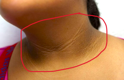 흑색가시세포증 치료 - 목, 겨드랑이에 거뭇하게 생기는 질환 치료법 (feat. 연고, 크림, 레이저 등) : 네이버 블로그