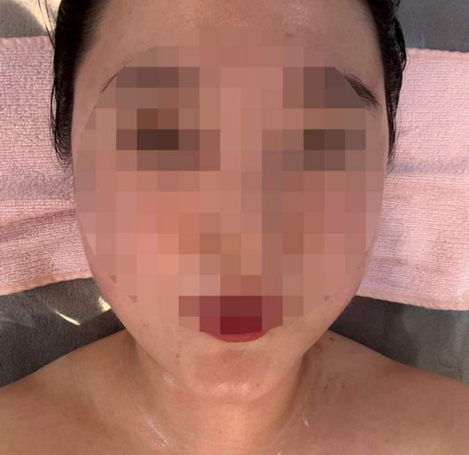 피부아지트(뉴페이스) 이미지