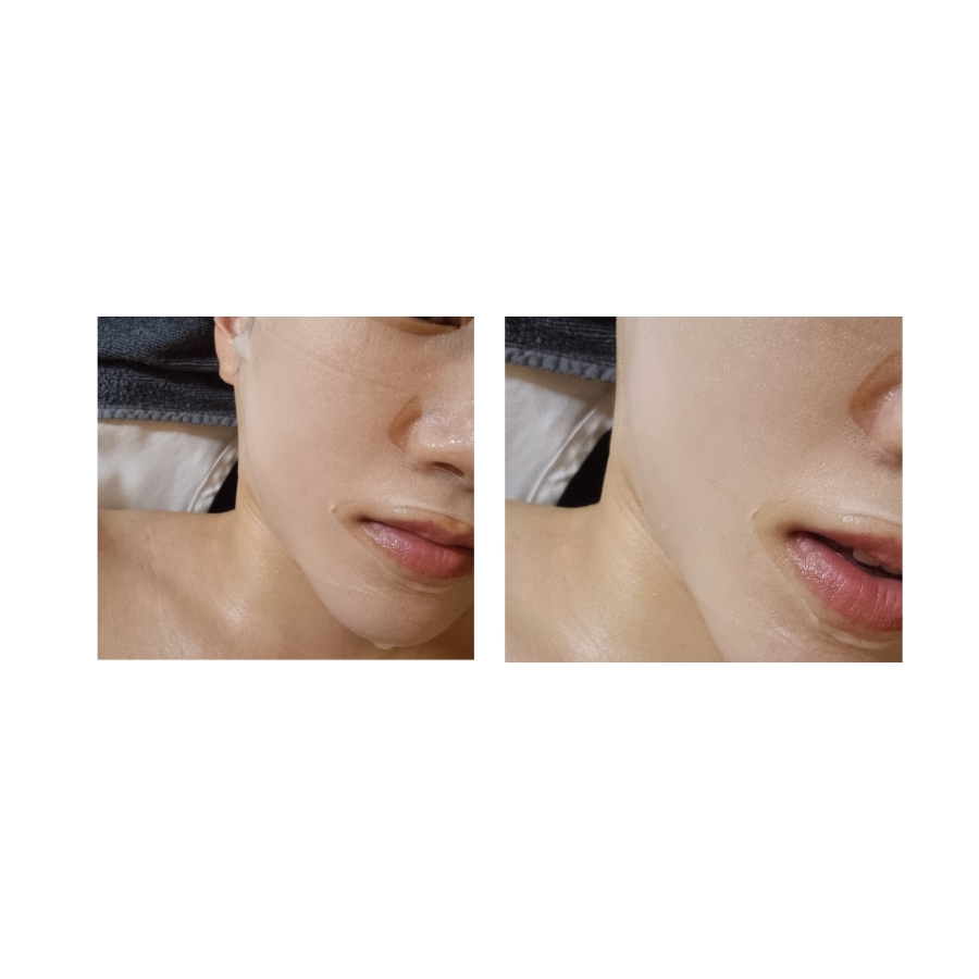 디프테라피 이미지