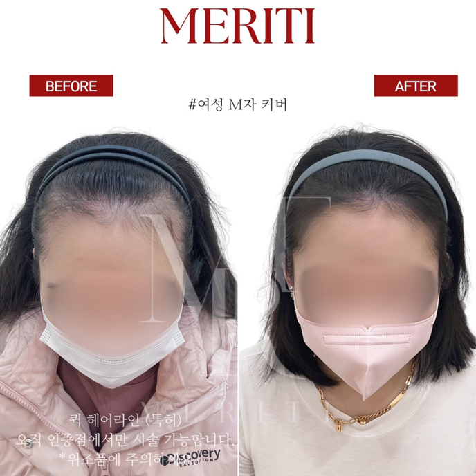 정 헤어라인 이미지