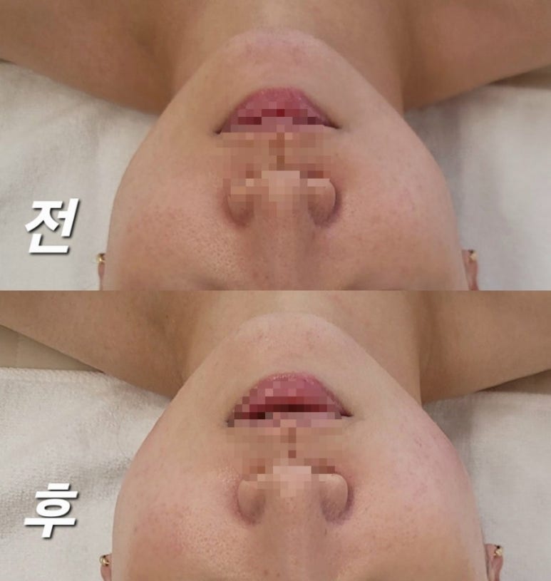 미모종결 이미지