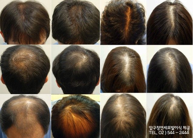 모발을 채우다 이미지