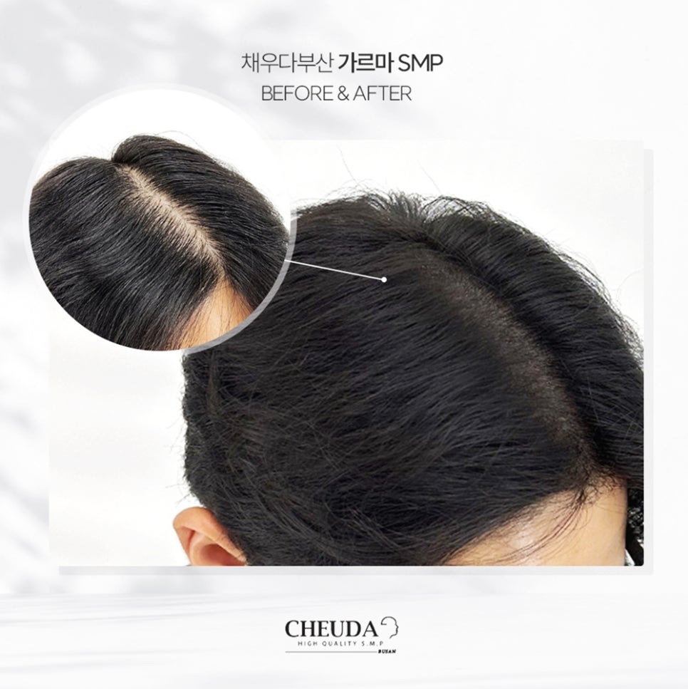 모발을 채우다 이미지