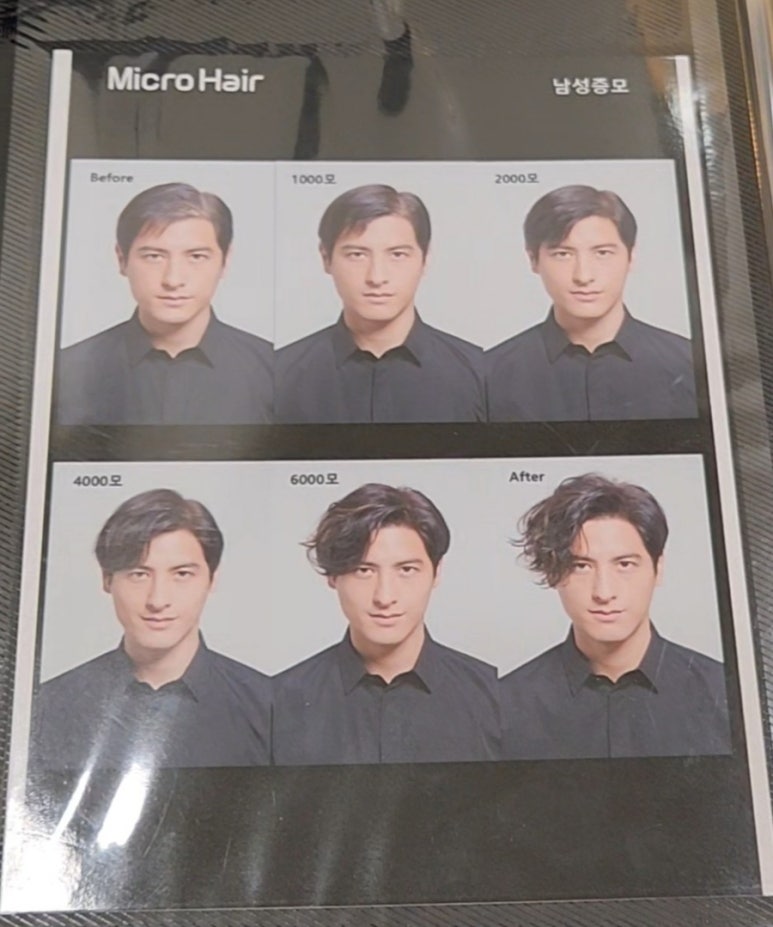 마이크로헤어증모 이미지