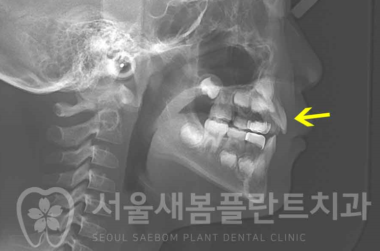 서울새봄플란트치과 이미지
