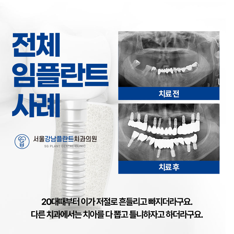 서울강남플란트치과 이미지