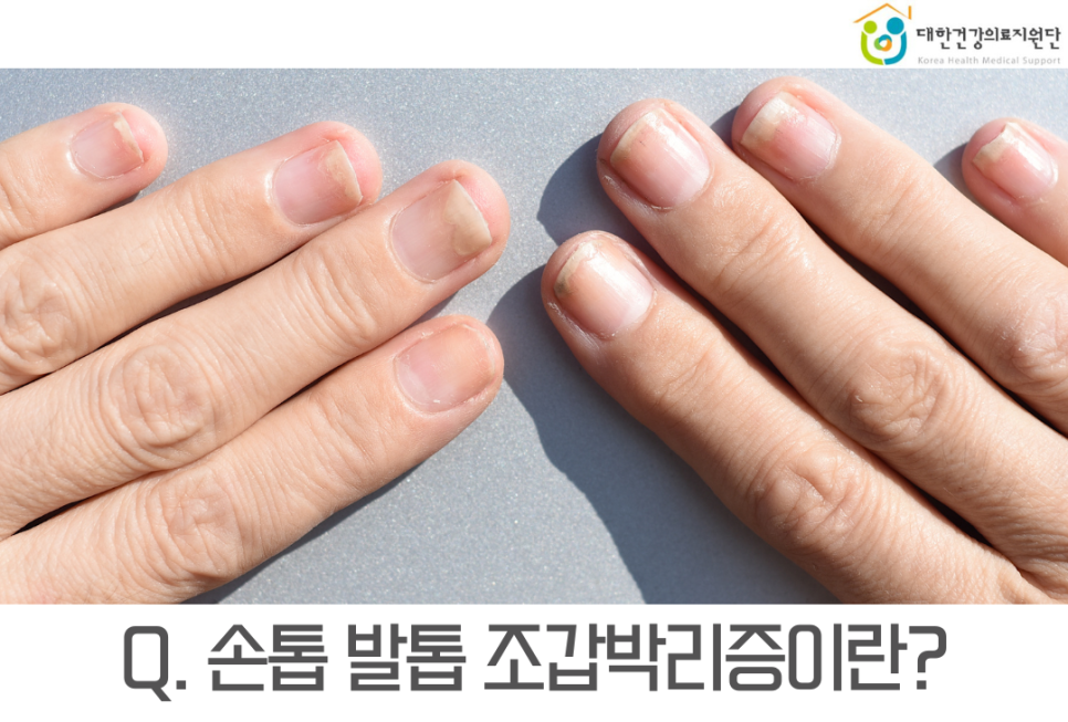 손톱발톱 이미지