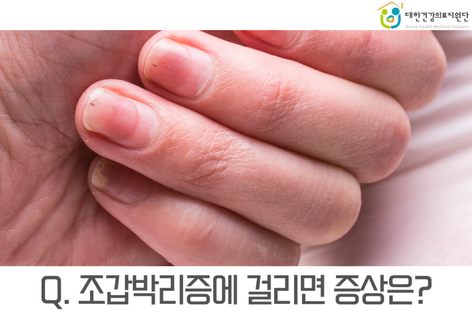 손톱발톱 이미지