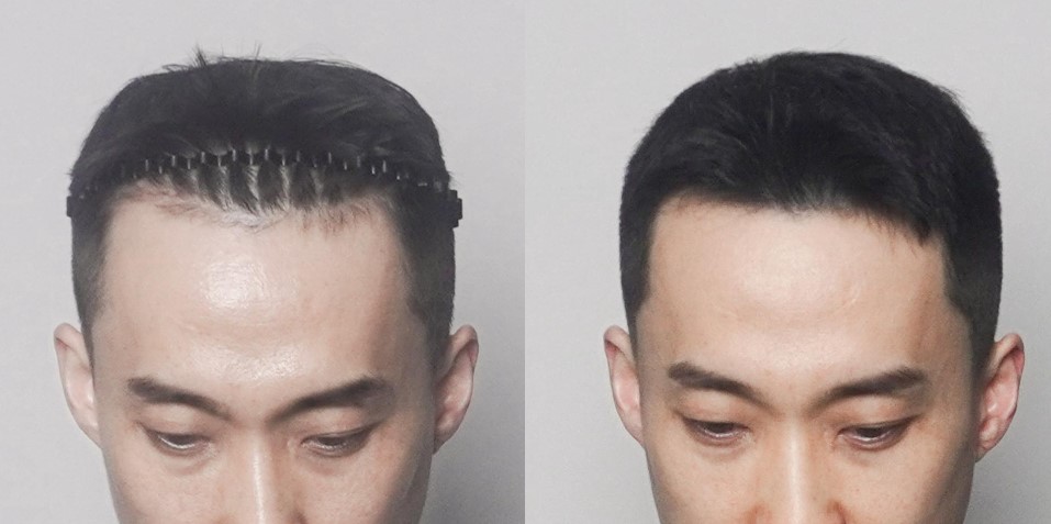 매직헤어라인 이미지