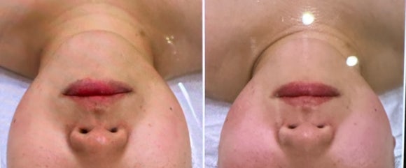어라운더 스킨 이미지
