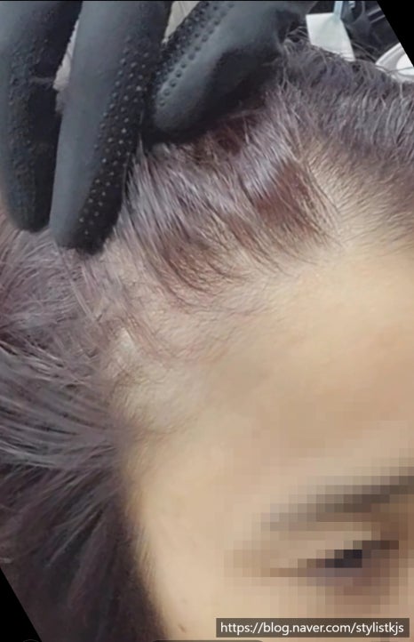 마샬헤어라인 이미지