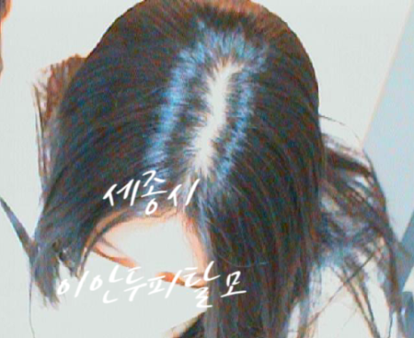 이안두피탈모 이미지