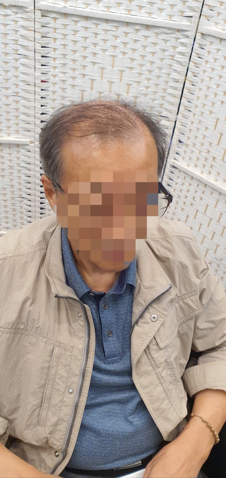 김호증모가발by헤어리서치 이미지